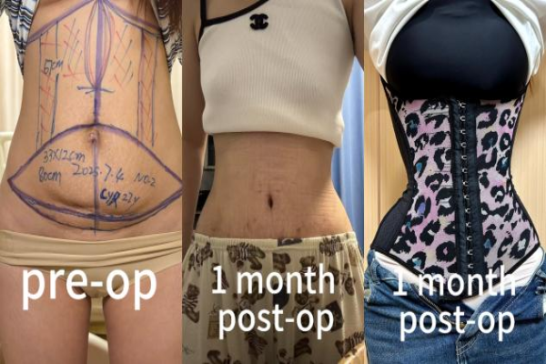 Restoring Confidence, Reshaping Lives: Transformative Abdominal Contouring Surgery