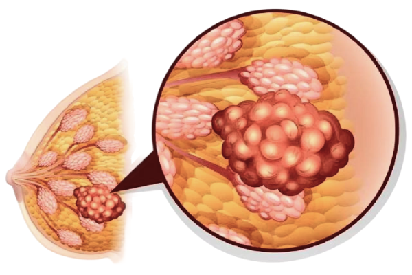 Breast Cancer
